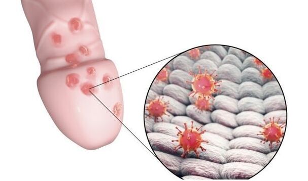allergie voor penisvergrotingsgel